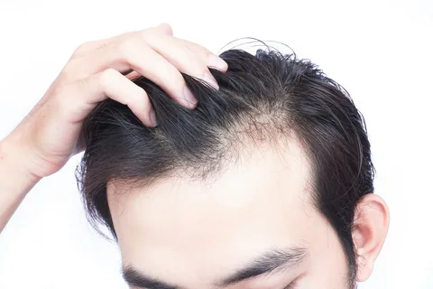 كيف يمكن للوراثة أن تؤثر على صحة شعر الرجال؟