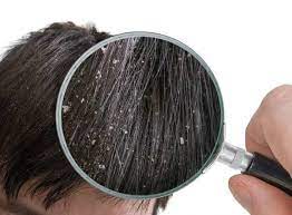التأثيرات الجانبية لاستخدام الأدوية المهدئة لتساقط الشعر عند المرأة المرضعة