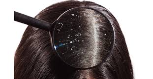 تأثير التغيرات الهرمونية على تساقط الشعر لدى البنات وكيفية التعامل معها